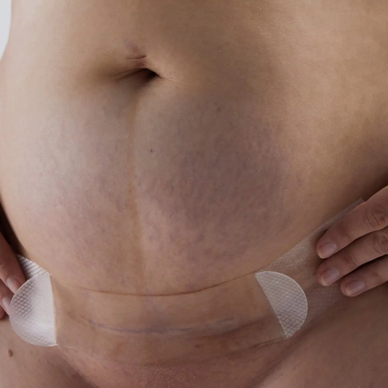 Silicone Gel Scar Strips