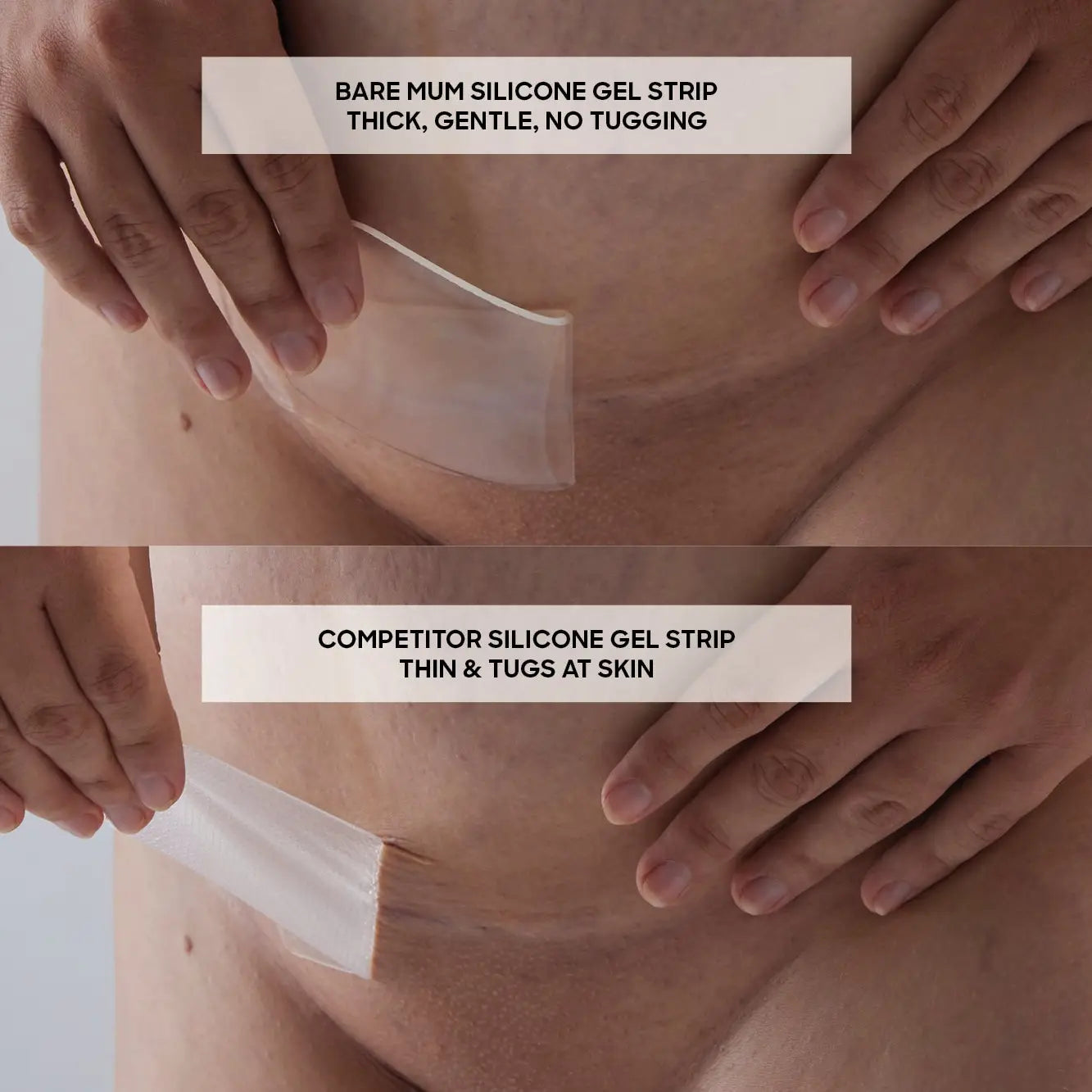 Silicone Gel Scar Strips